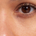 Treatment Image 12
